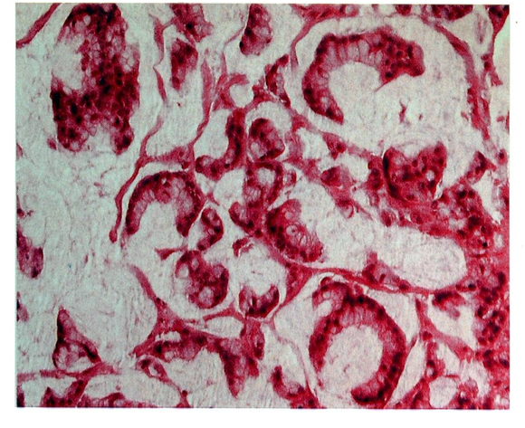 Figure 6) Adénocarcinome mucineux: plages de mucus hébergeant des structures glandulaires tumorales.