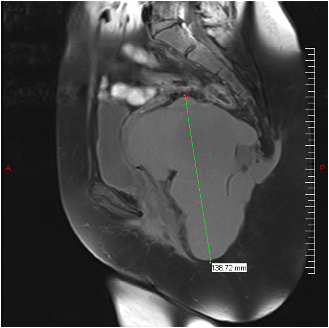 Figure1)IRM = Tumeur de 14 cm allant jusqu'a la région ischio anale  et en retro-coccygien
