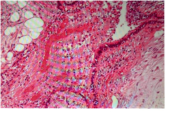 Fig. 2) Hamartome: Cavité kystique disposée dans un tissu fibro-adipeux. La cavité kystique est bordée par un épithélium de type mucosécrétant.