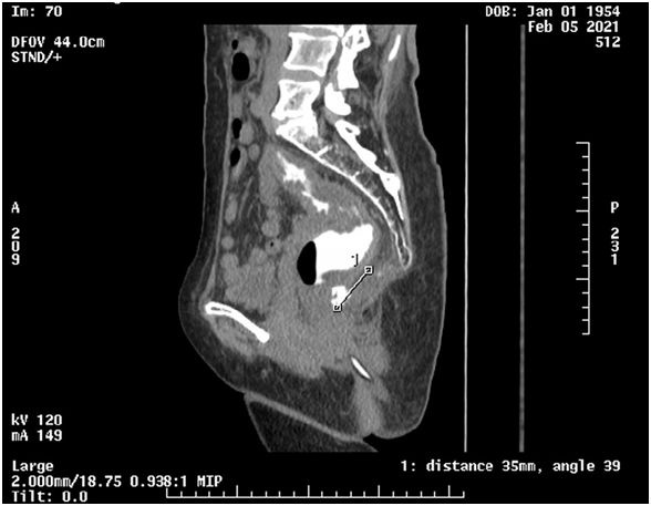 Figure4)Tumeur faisant 3,5cm retro rectale