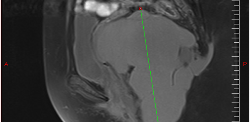 Adénocarcinome retro-rectal 7 ans post excision d’un tailgut-cyst, rapport d’un cas et propositions pour prévenir la récidive.