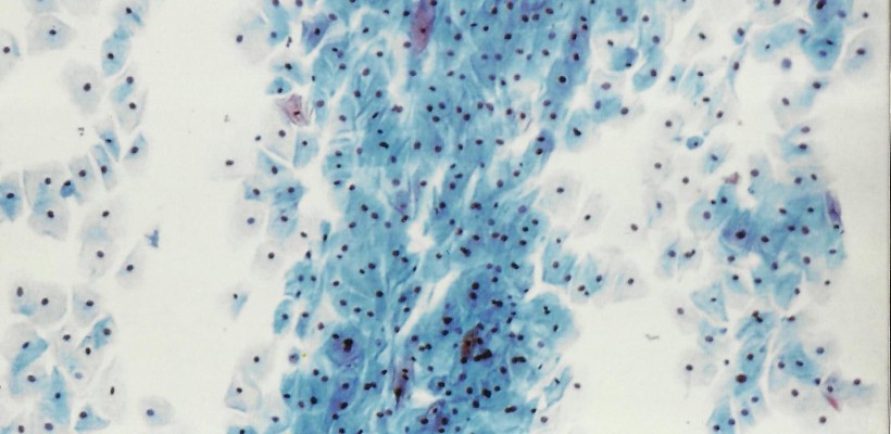 Greffes De Cellules Souches