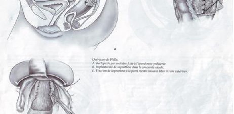 TRAITEMENTS DES RECIDIVES - PROLAPSUS TOTAL DU RECTUM A PROPOS DE 7 CA